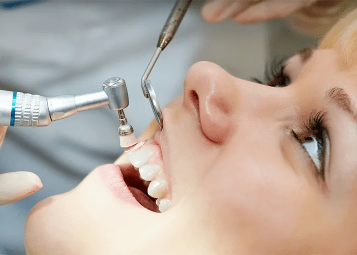 Best Teeth Polishing Treatment in Lahore